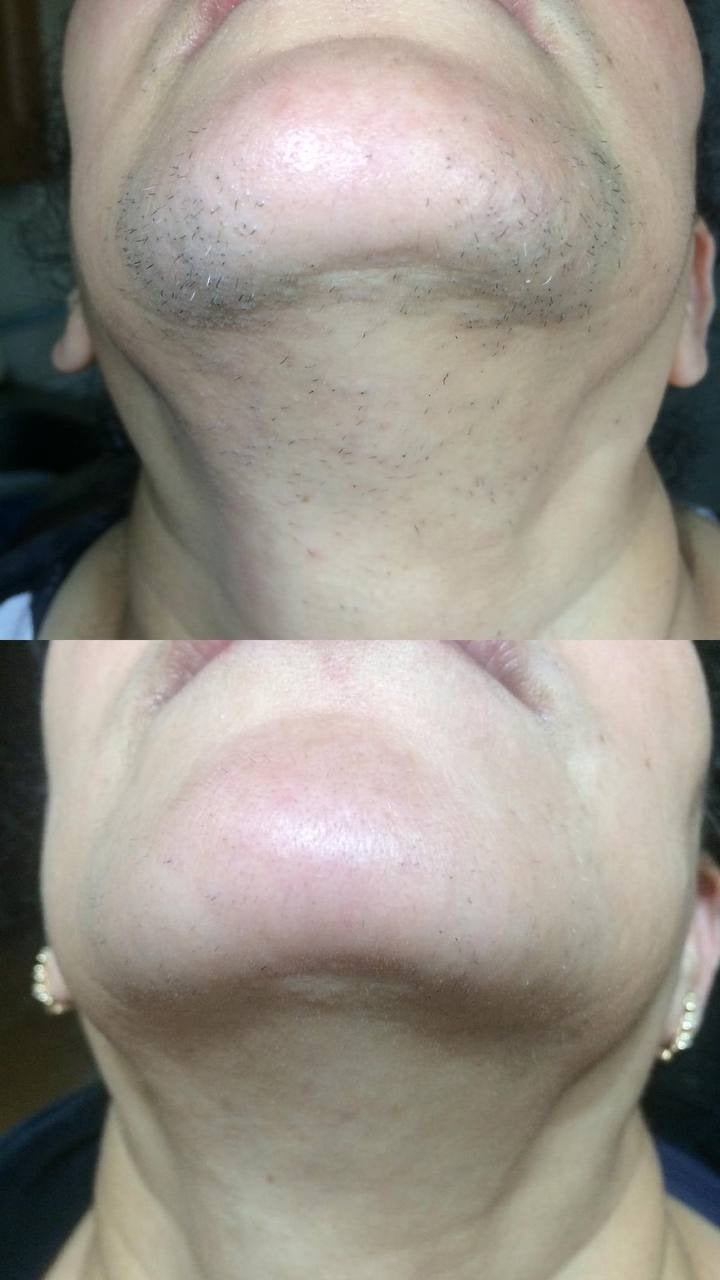 Chin and neck, before and after laser hair removal treatment