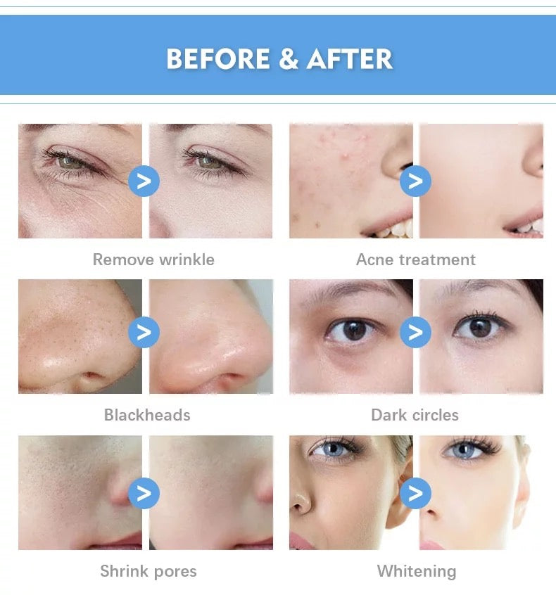 Before and After Use of Hydrafacial Machine, remove wrinkle, acne, blackhead, dark circles, shrink pores, whiten