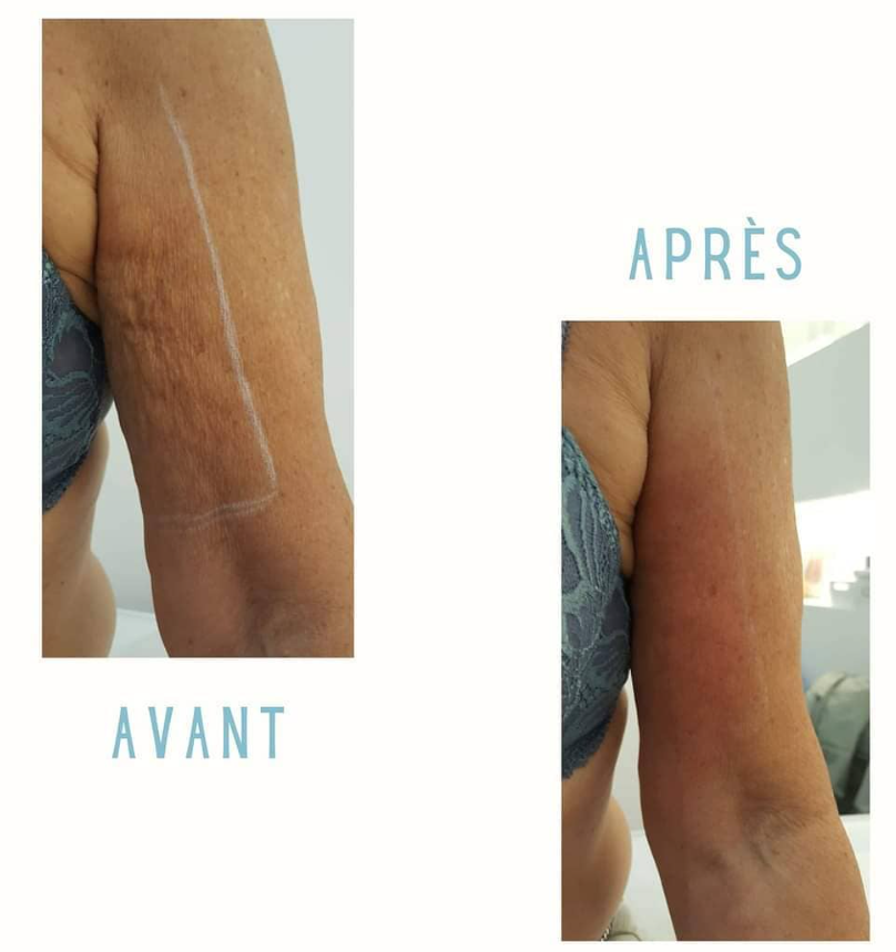 Reveal PRO SuperPulse CO2 Laser (Digital)