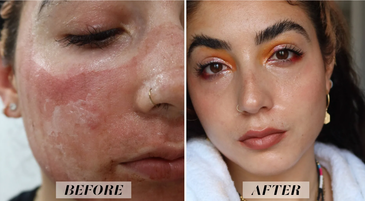 Reveal PRO SuperPulse CO2 Laser (Digital)