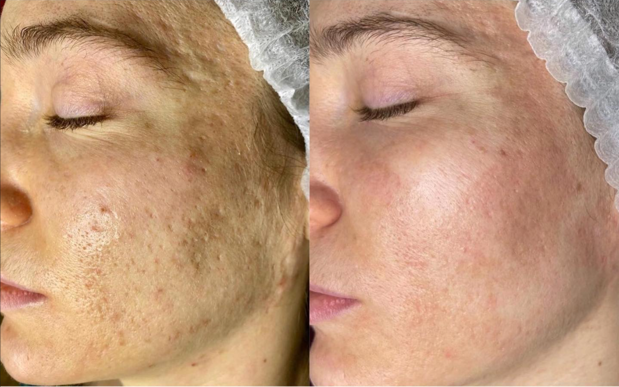 Reveal PRO SuperPulse CO2 Laser (Digital)