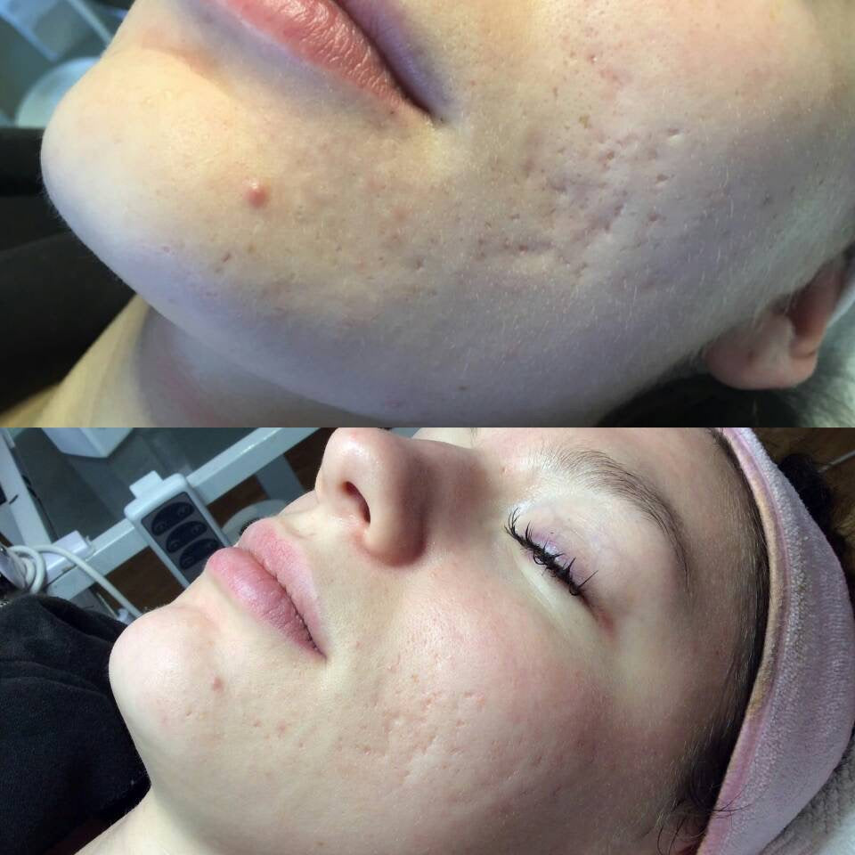 Reveal PRO SuperPulse CO2 Laser (Digital)