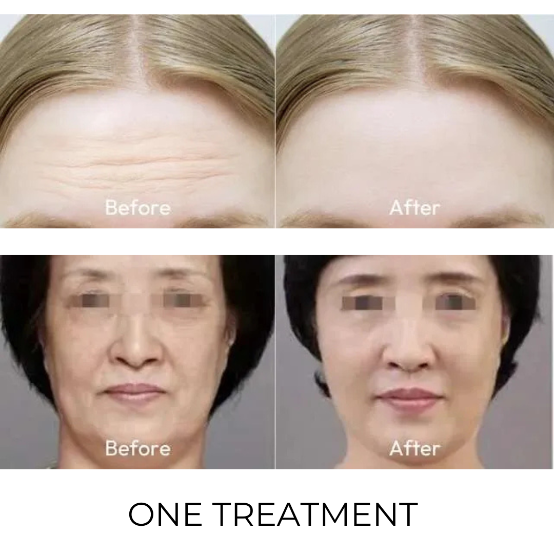 LuminaTight™ 10D HIFU Machine Professional