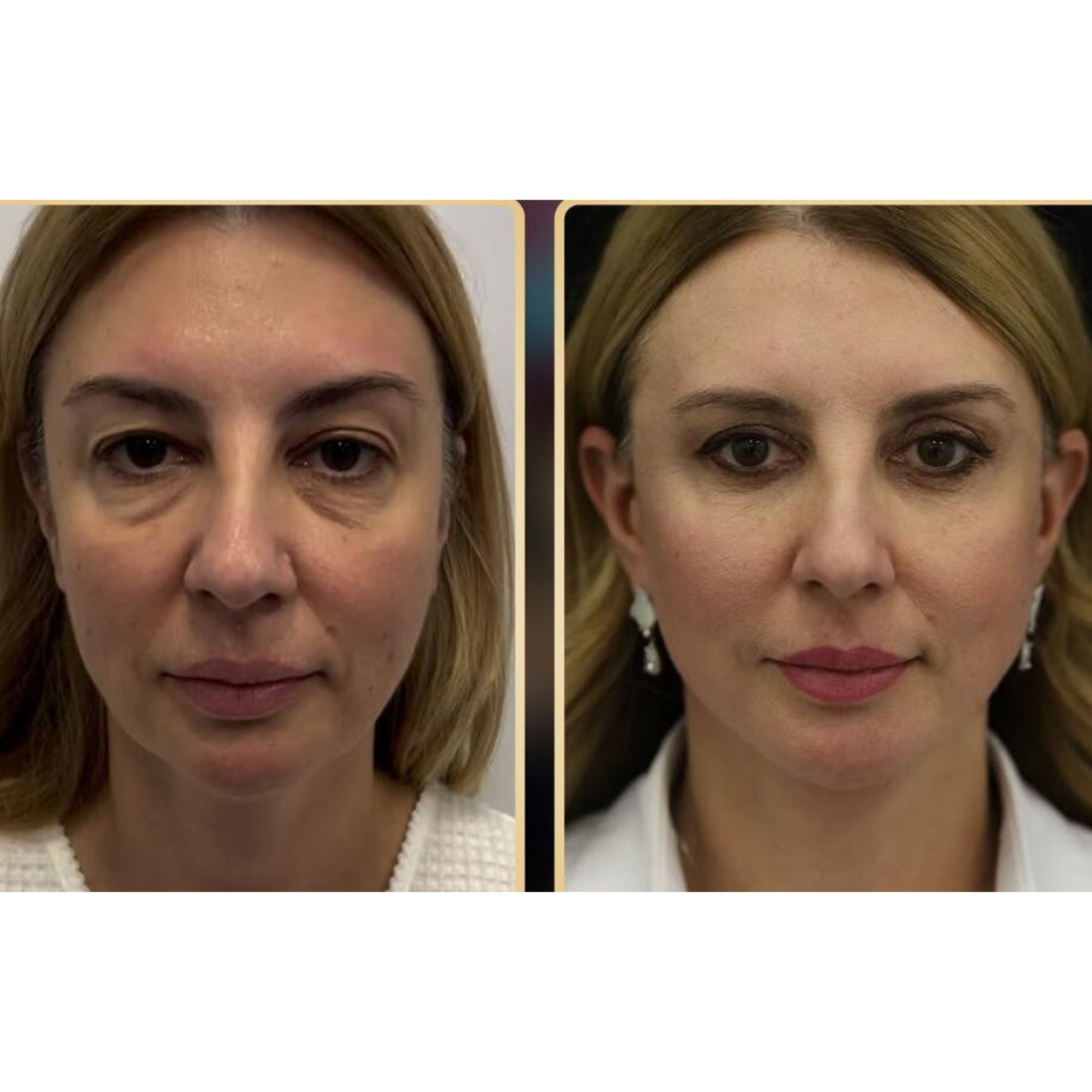 Professional PERFECT SHAPE® NEO PLUS (Body & Face)