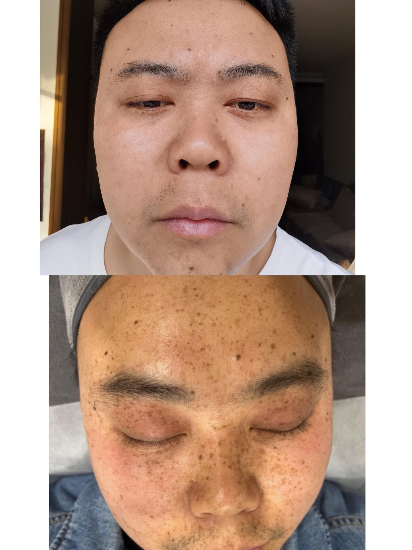 PicoPretty® Picosecond Laser - Complete Pigment Solution