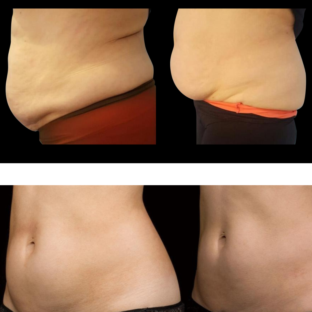 Before-and-after abdominal body contouring results shown from front and side views